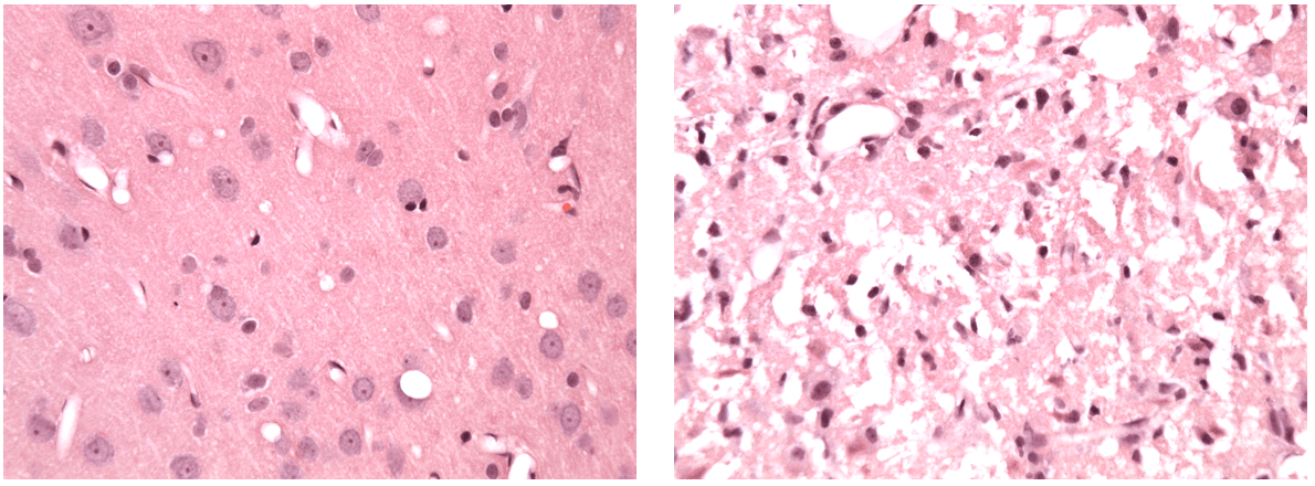 Light microscopic images (x40 magnification) of H&E-stained brain tissue post-stroke. The left image presents unaffected tissue from the ipsilateral hemisphere. The right image exhibits the infarct.