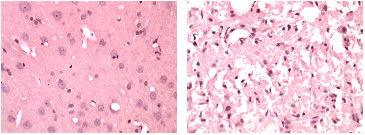 Light microscopic images (x40 magnification) of H&E-stained brain tissue post-stroke. The left image presents unaffected tissue from the ipsilateral hemisphere. The right image exhibits the infarct.