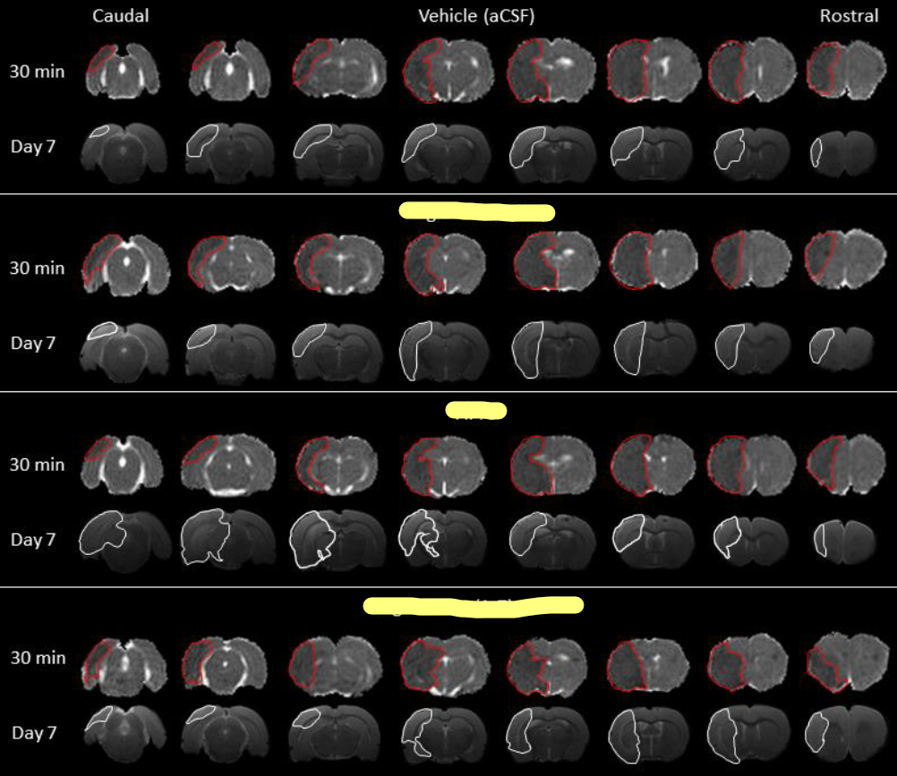 This image exemplifies the image analysis I performed today. These are brain scans taken 30 minutes and 7 days post-stroke, where I've highlighted the areas of brain damage in red and white. For confidentiality reasons, I've concealed the three treatment types.