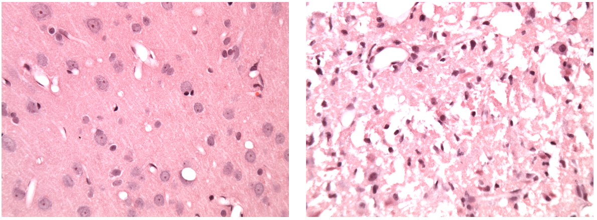 Light microscopic images (x40 magnification) of H&E-stained brain tissue following a stroke. The left image shows unaffected tissue from the ipsilateral hemisphere. The right image shows the infarct.